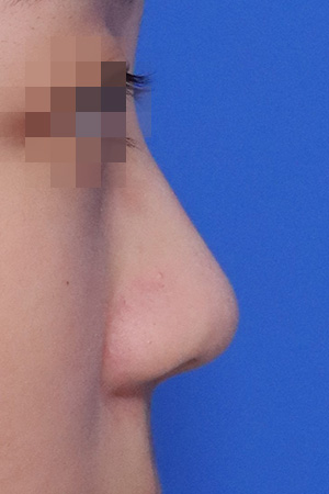 Bulbous tip correction with bridge augmentation — before and after