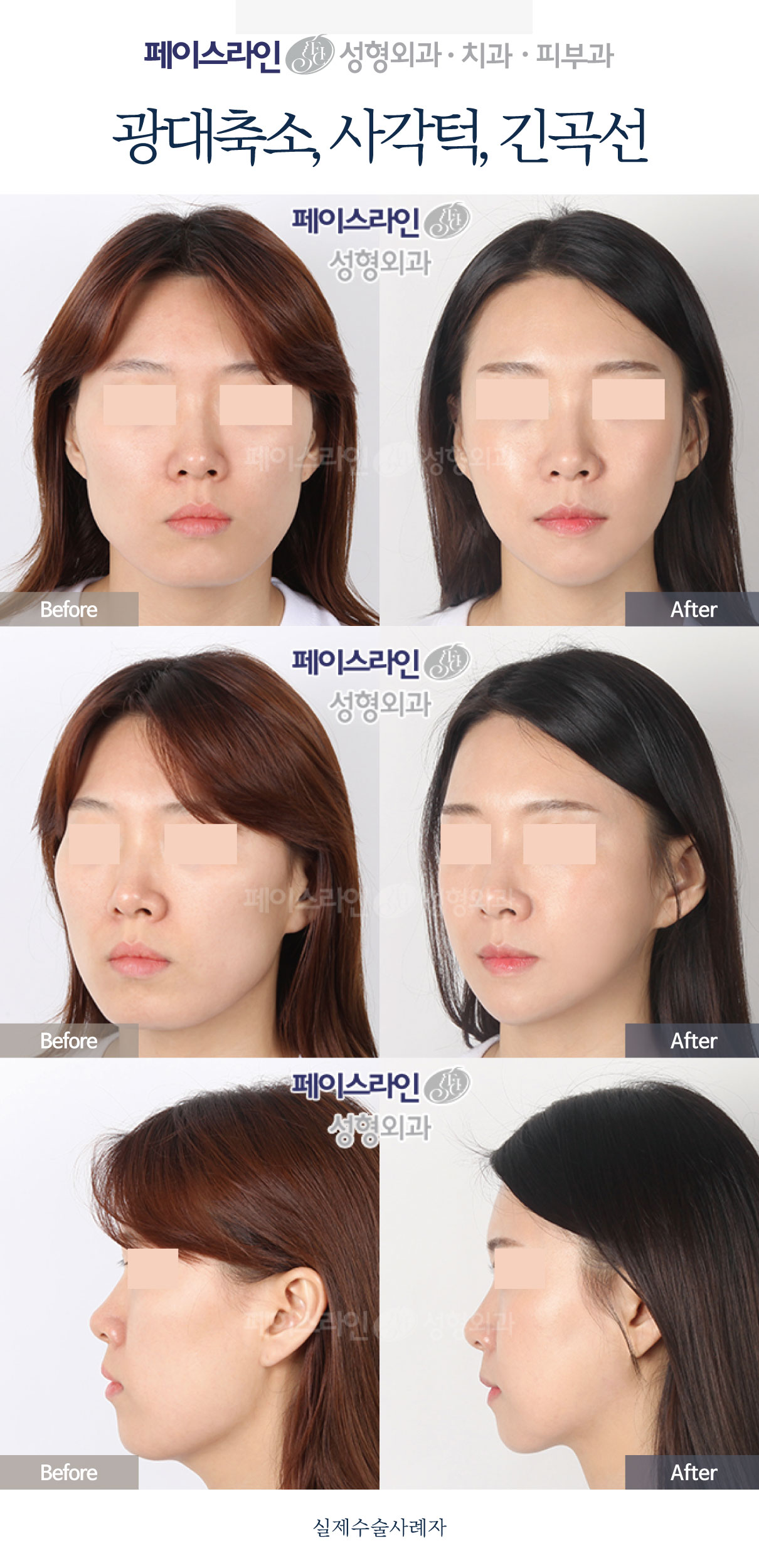 Cheekbone and jaw-angle reduction: comparison 01 — before and after