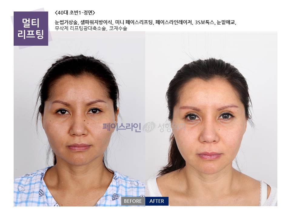 Multi-lifting with brow, cheekbone and nose surgery — before and after