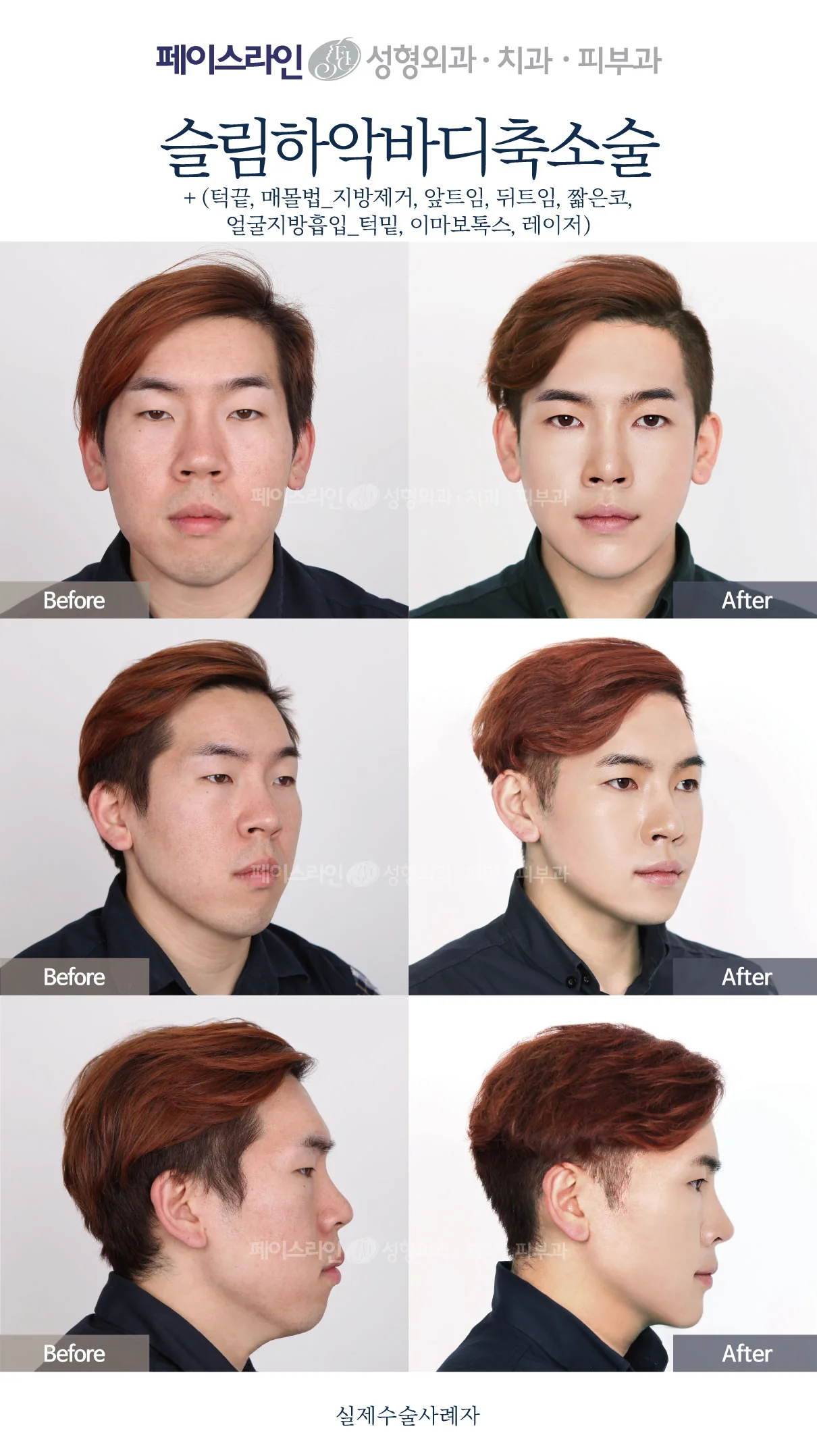 Lower jaw reduction with nose and eyelid surgery — before and after