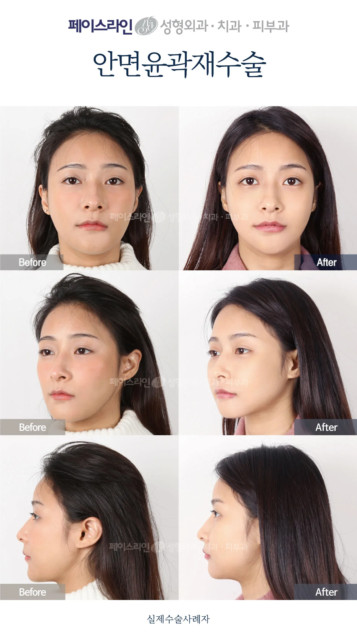 Revision facial contouring — three views — before and after