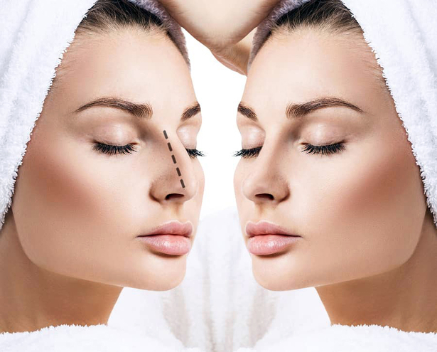 Results after rhinoplasty for Hump Nose