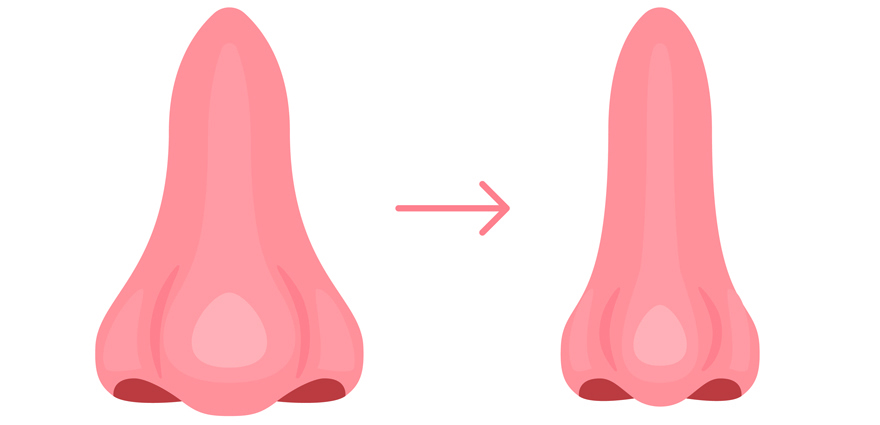 Alar Reduction