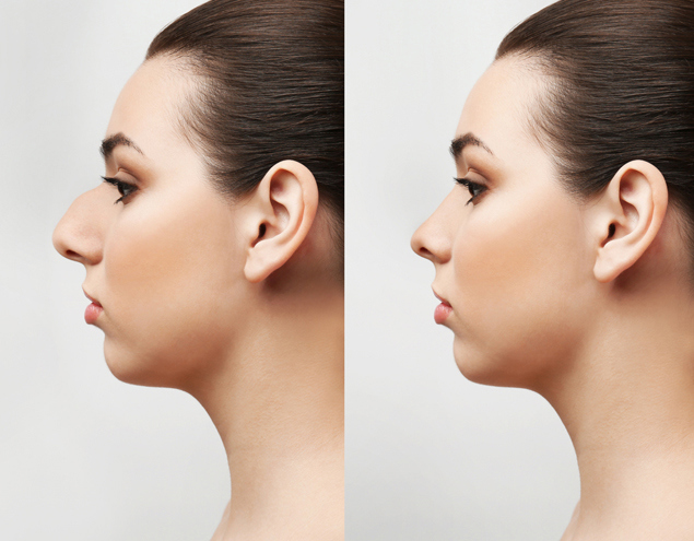 Aesthetic Results with Silicone Implants