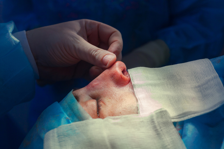 Step-by-Step Process of Fixing a Broken Nose with Male Rhinoplasty