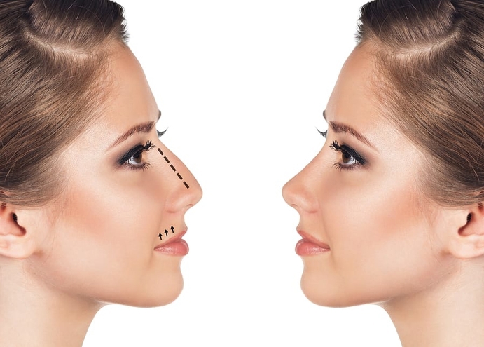 Real-Life Results: Before and After Rhinoplasty