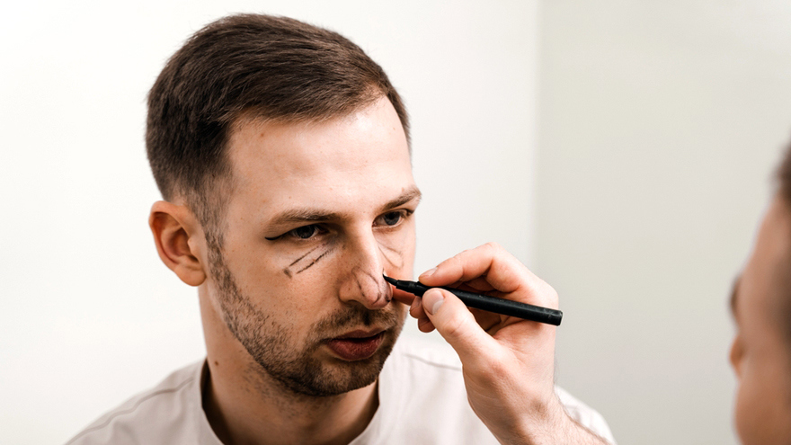 Male Rhinoplasty