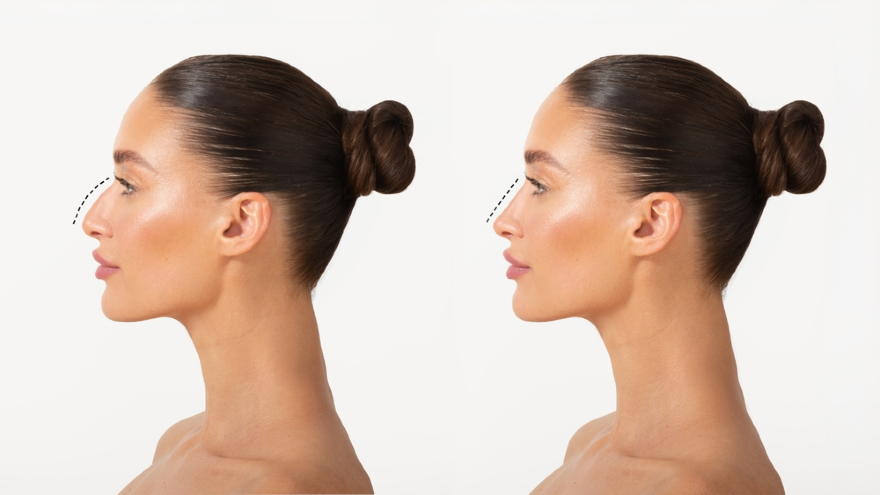 Rhinoplasty Results