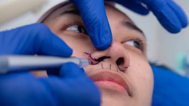 Bulbous Nose Rhinoplasty Treatment Process