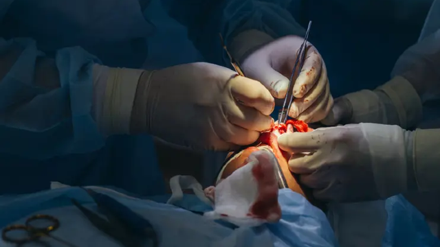 Male Rhinoplasty, Male Revision Rhinoplasty, Dorsal Hump Reduction
