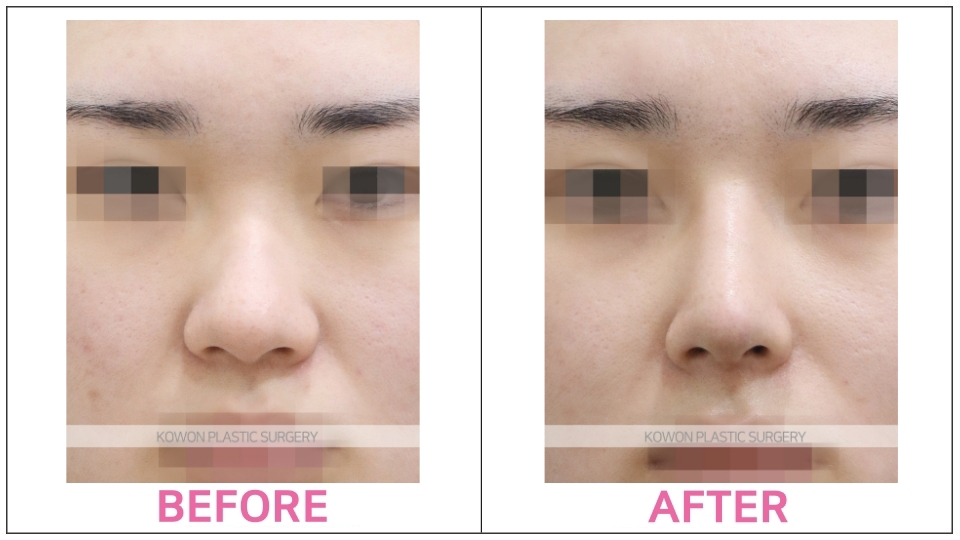Dorsal Hump Reduction before and after