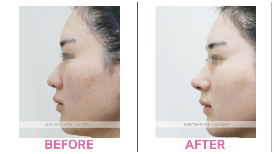 Rhinoplasty