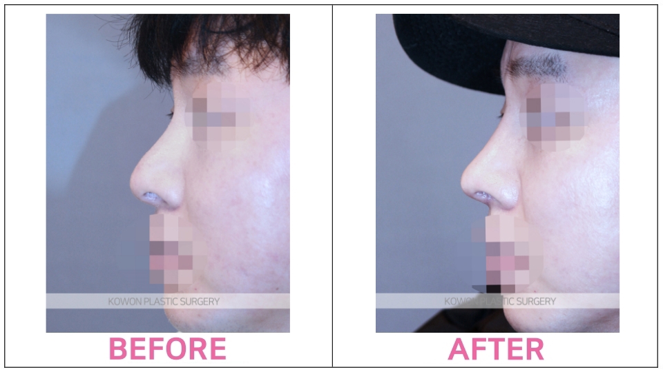 Non-implant Rhinoplasty before and after
