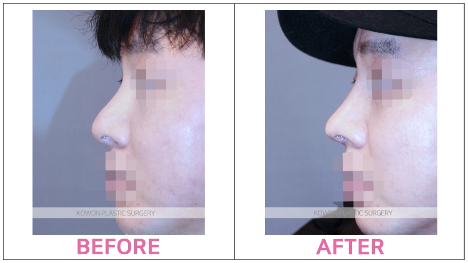 Rhinoplasty