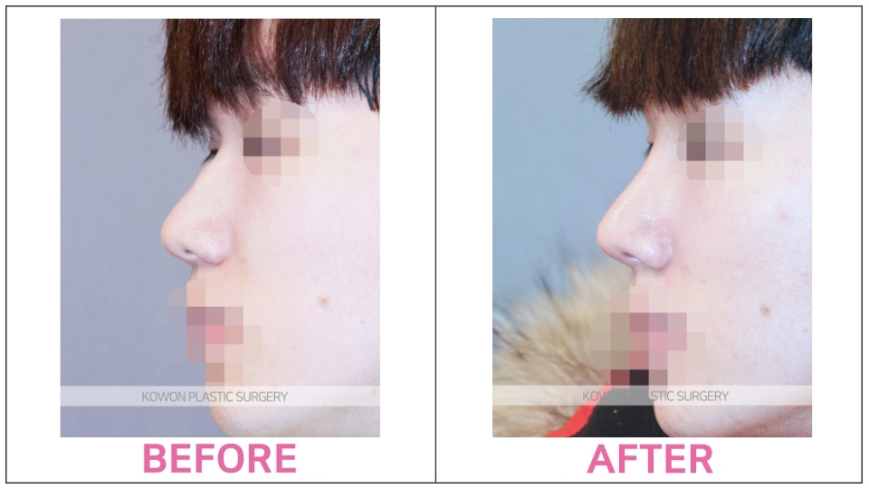 Dorsal Hump Reduction before and after