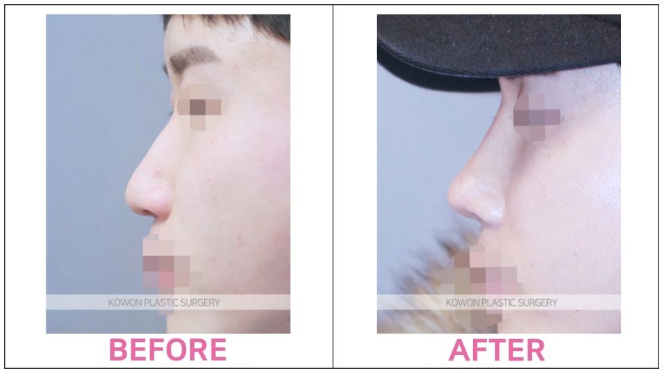 Silicone Implant Rhinoplasty before and after