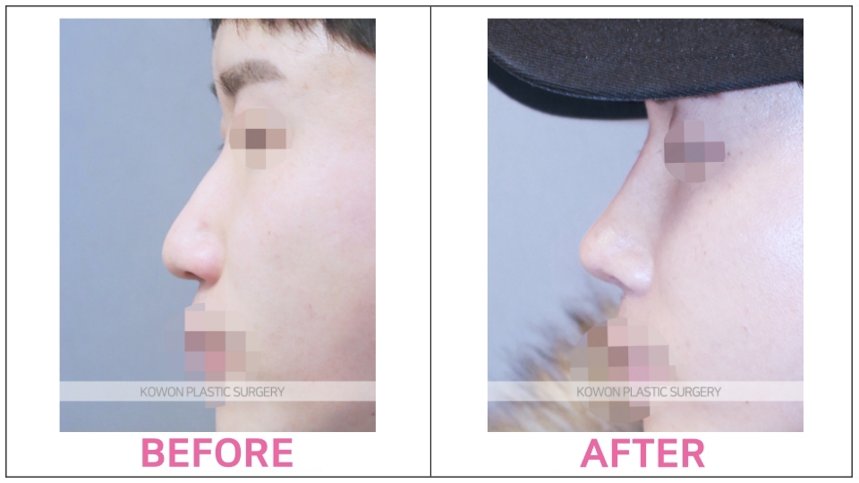 Rhinoplasty