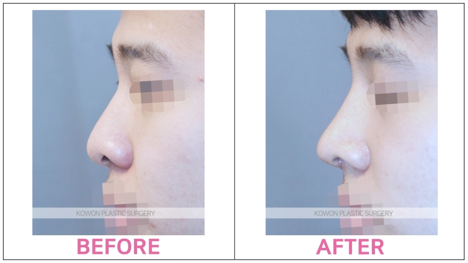 Silicone Implant Rhinoplasty before and after
