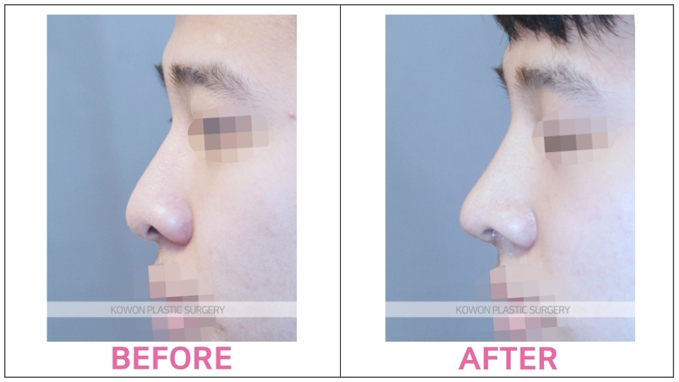 Rhinoplasty