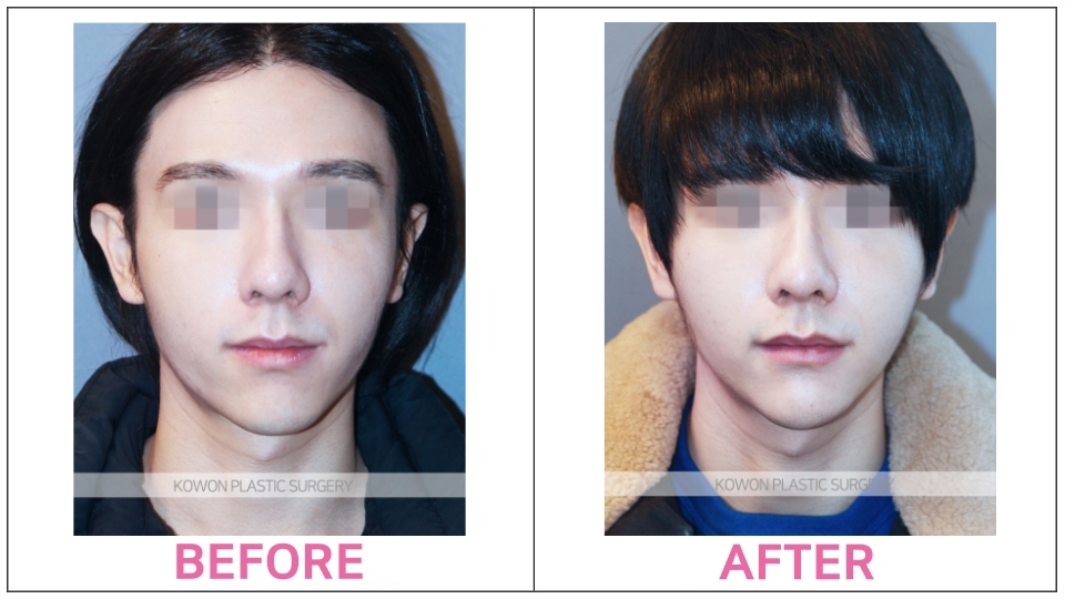 Long Nose Rhinoplasty before and after