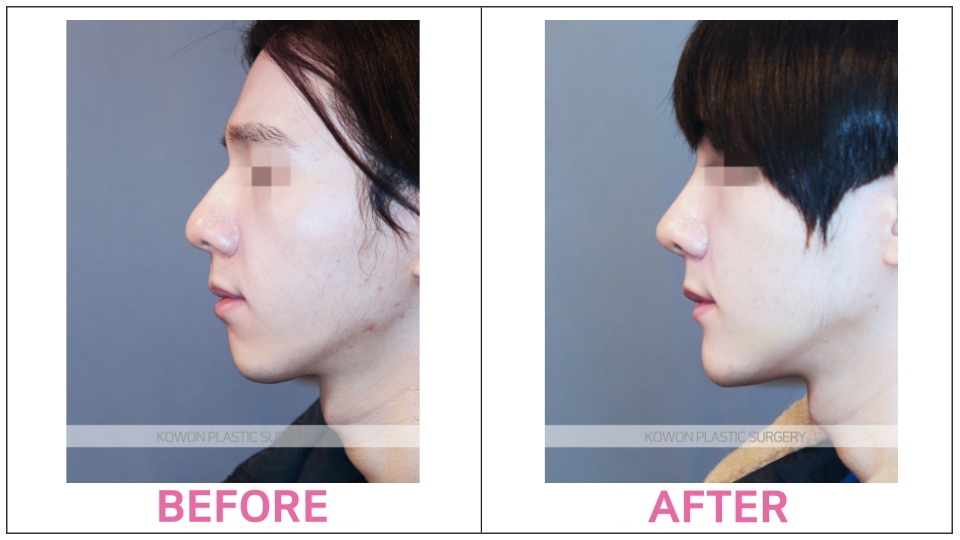 Male Rhinoplasty before and after