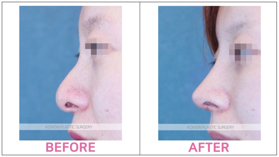 Male Rhinoplasty before and after