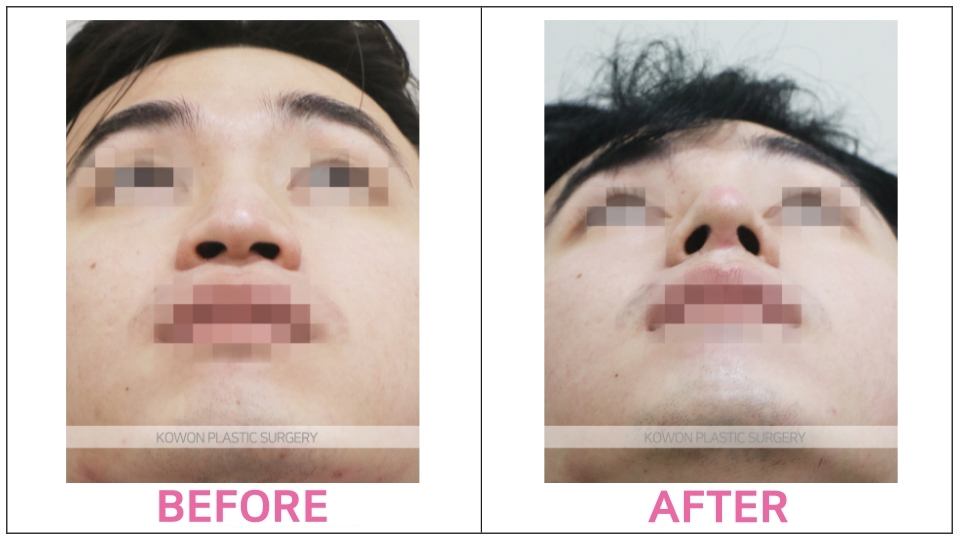 Rhinoplasty