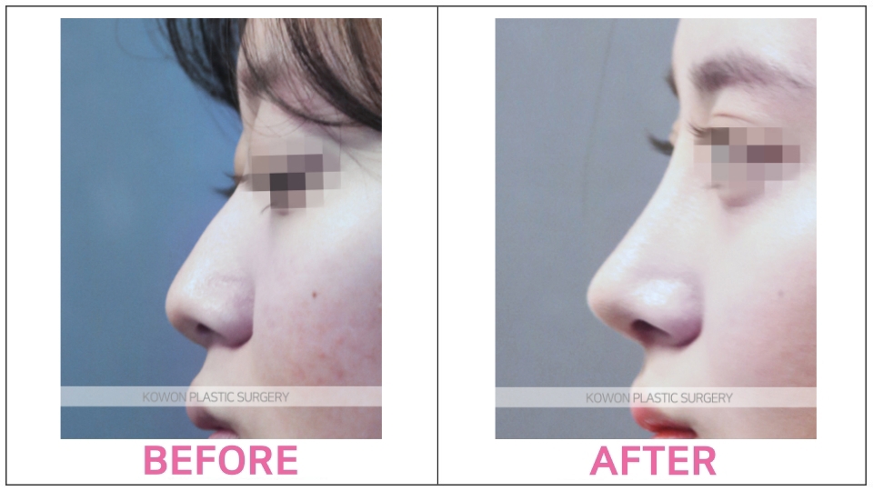 Functional Rhinoplasty before and after