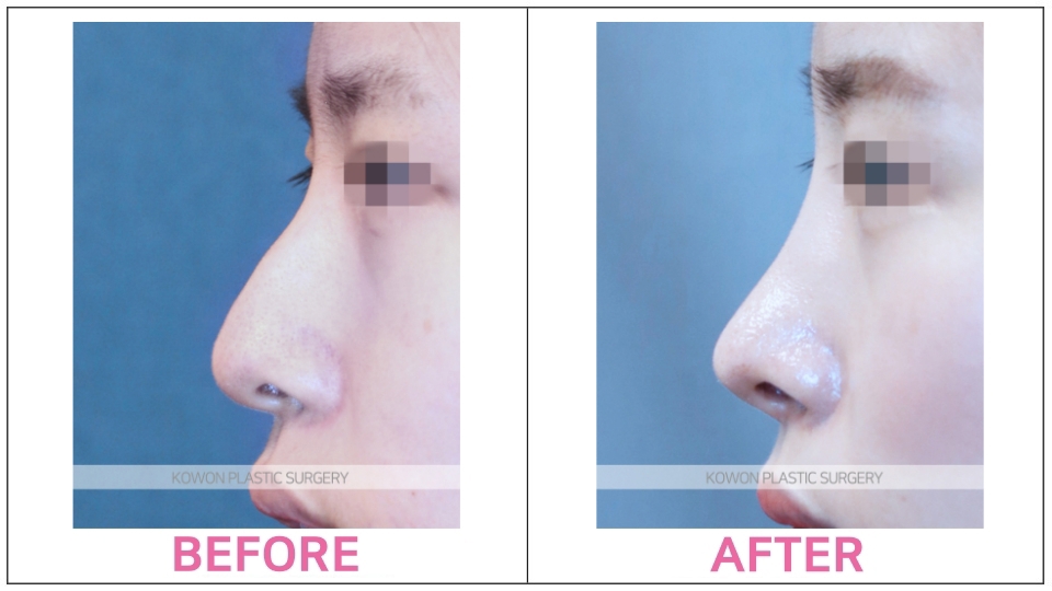 Short Nose Rhinoplasty before and after