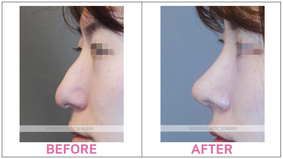 Rhinoplasty (Aquiline Nose)