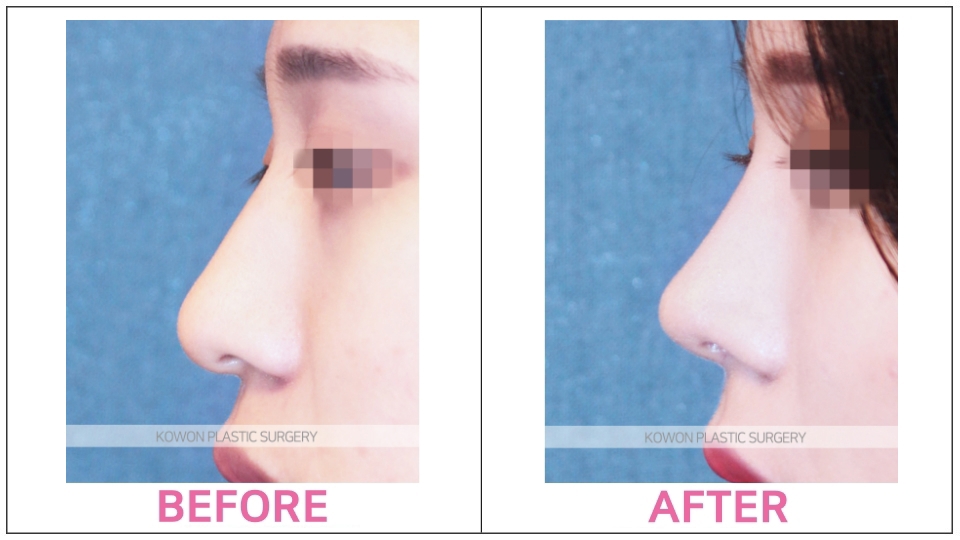 Nose Filler Treatment before and after