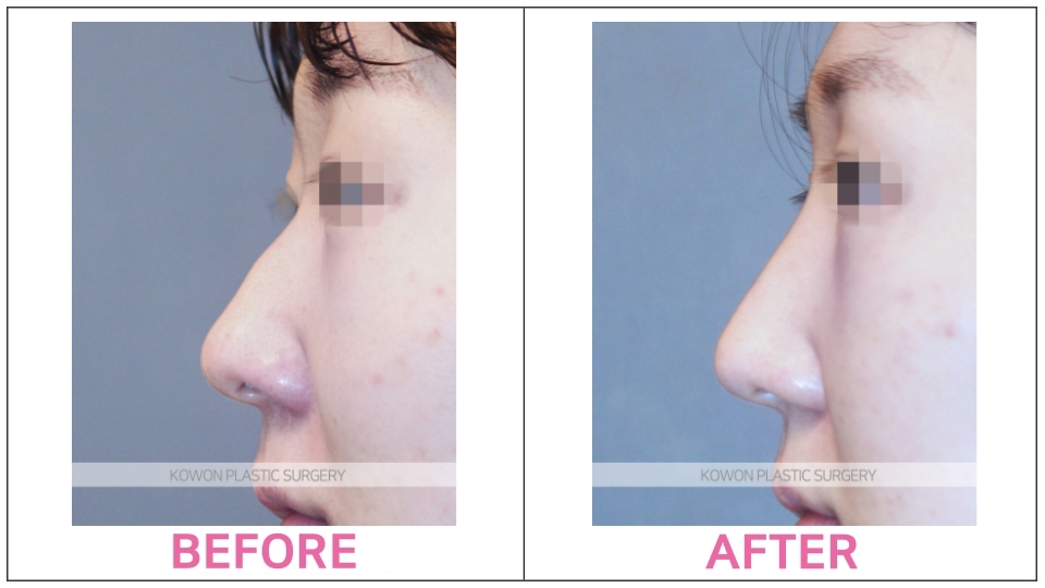 Rhinoplasty (Aquiline Nose)