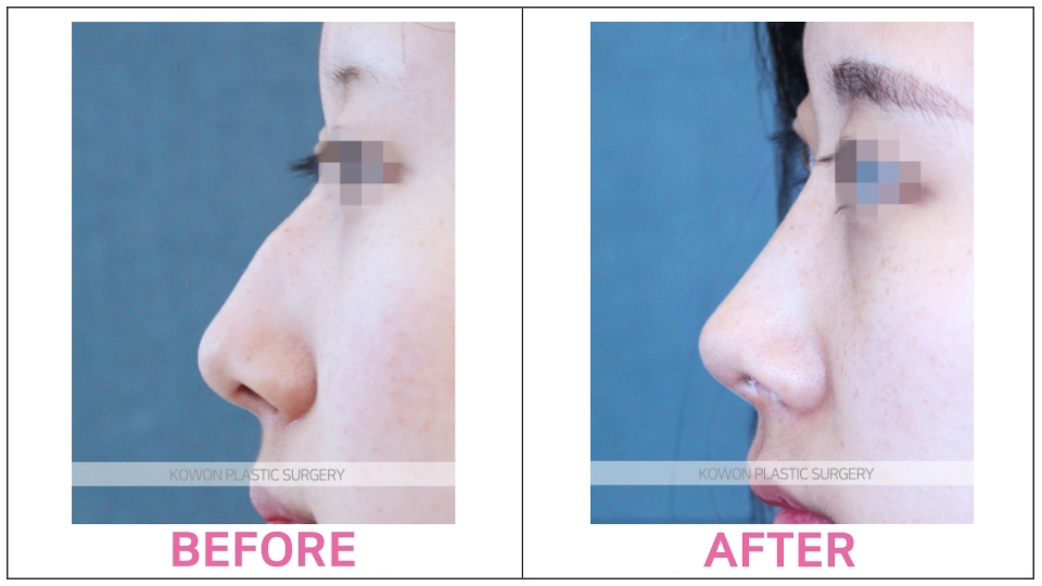 Tip Rhinoplasty before and after