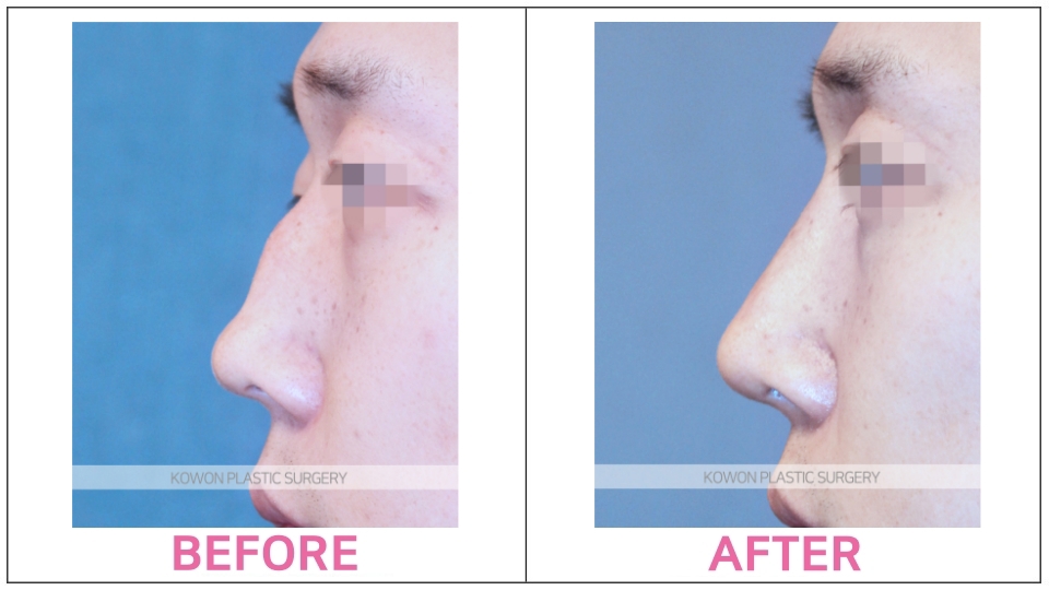 Rhinoplasty (Aquiline Nose)