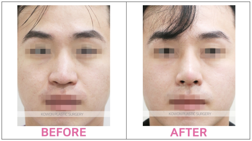Rhinoplasty