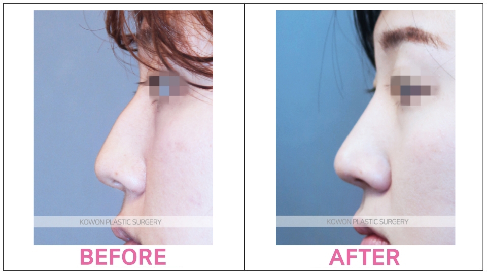 Tip Rhinoplasty