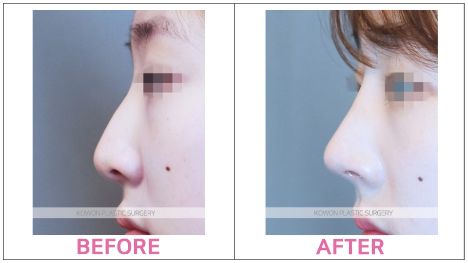 Open Rhinoplasty efore and after