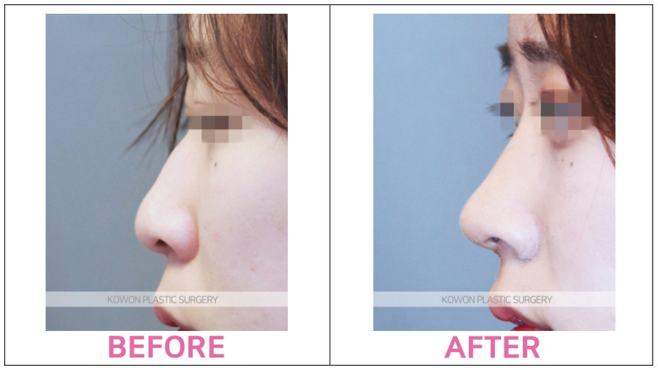 Hump Nose Rhinoplasty before and after