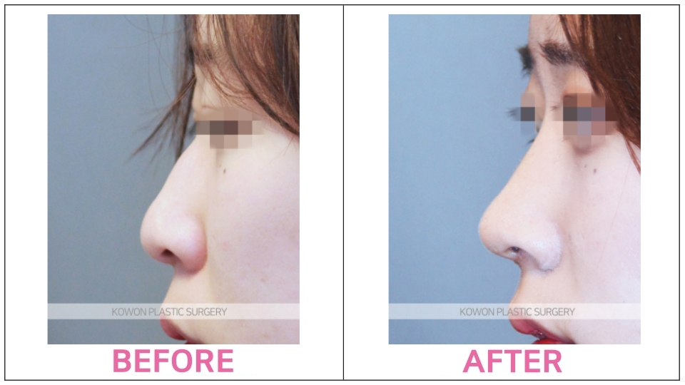 Rhinoplasty (Aquiline Nose)