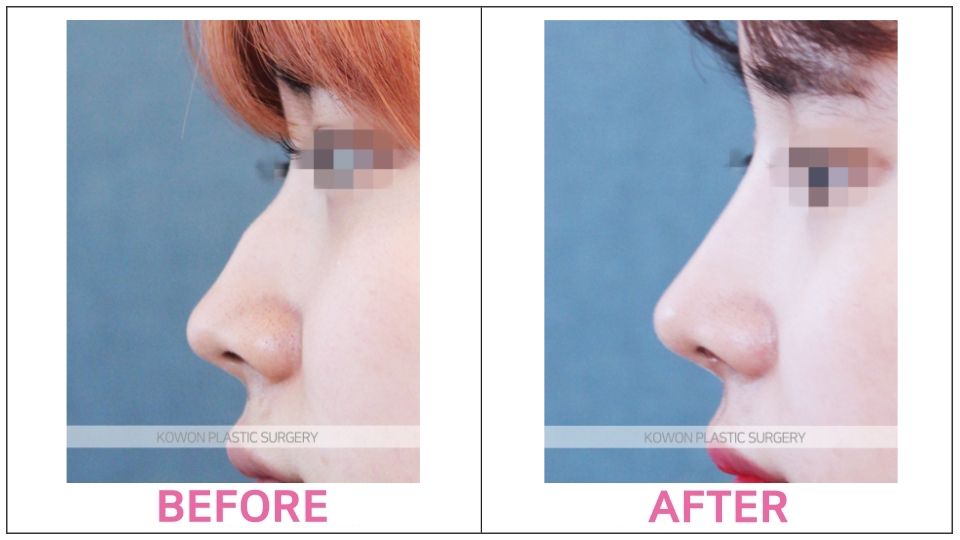 Hump Nose Rhinoplasty before and after