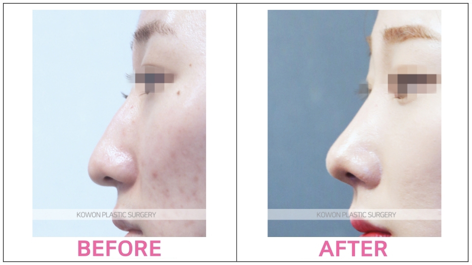 Short Nose Rhinoplasty before and after