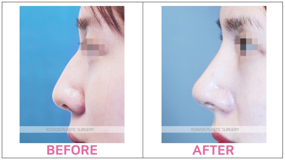 Rhinoplasty (Aquiline Nose)