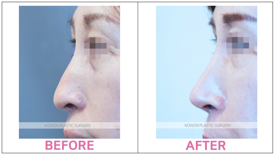 Closed Rhinoplasty before and after