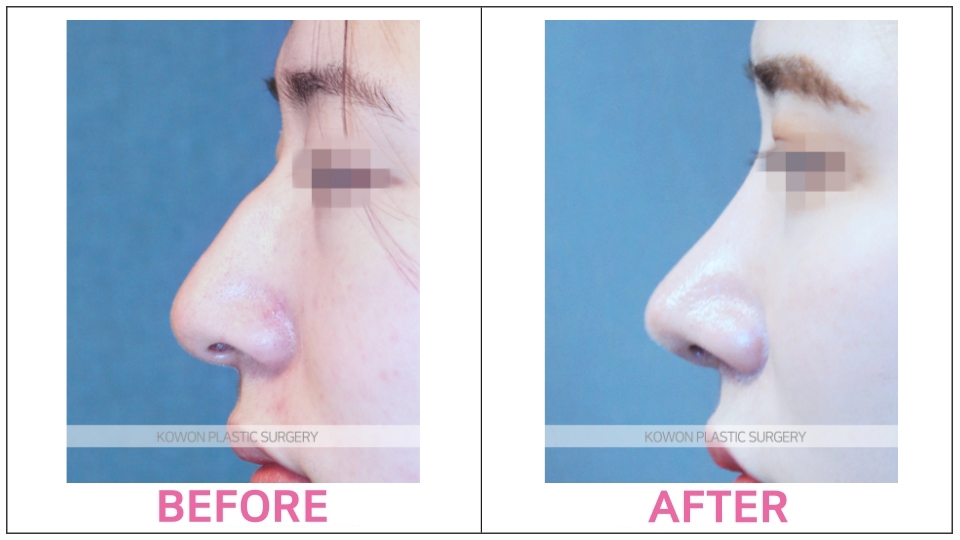 Rhinoplasty (Aquiline Nose)