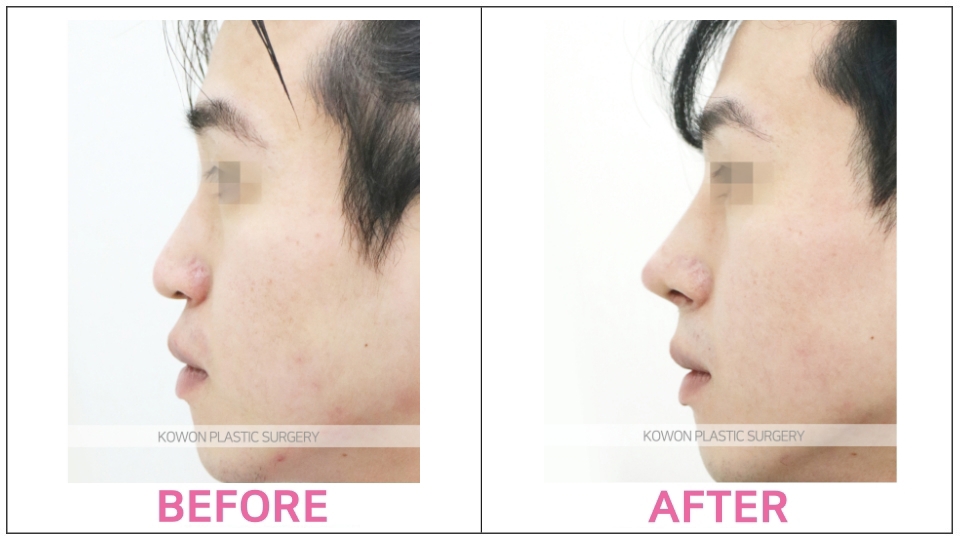 Autologous Graft Rhinoplasty before and after
