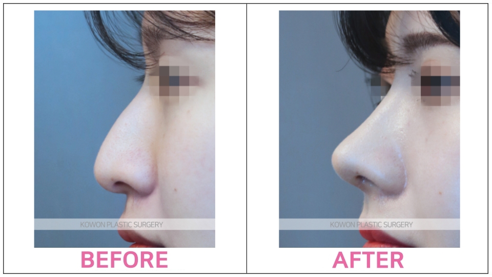 Rhinoplasty (Aquiline Nose)
