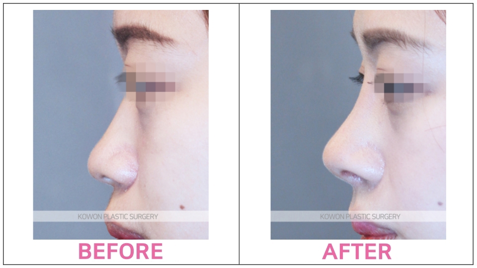 Minor Revision Rhinoplasty before and after