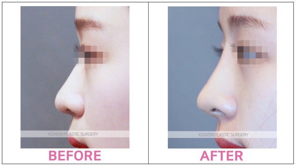 Revision Rhinoplasty before and after