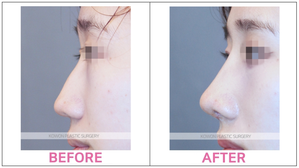 Bulbous Nose Rhinoplasty before and after