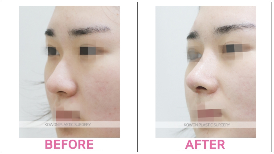 Rhinoplasty